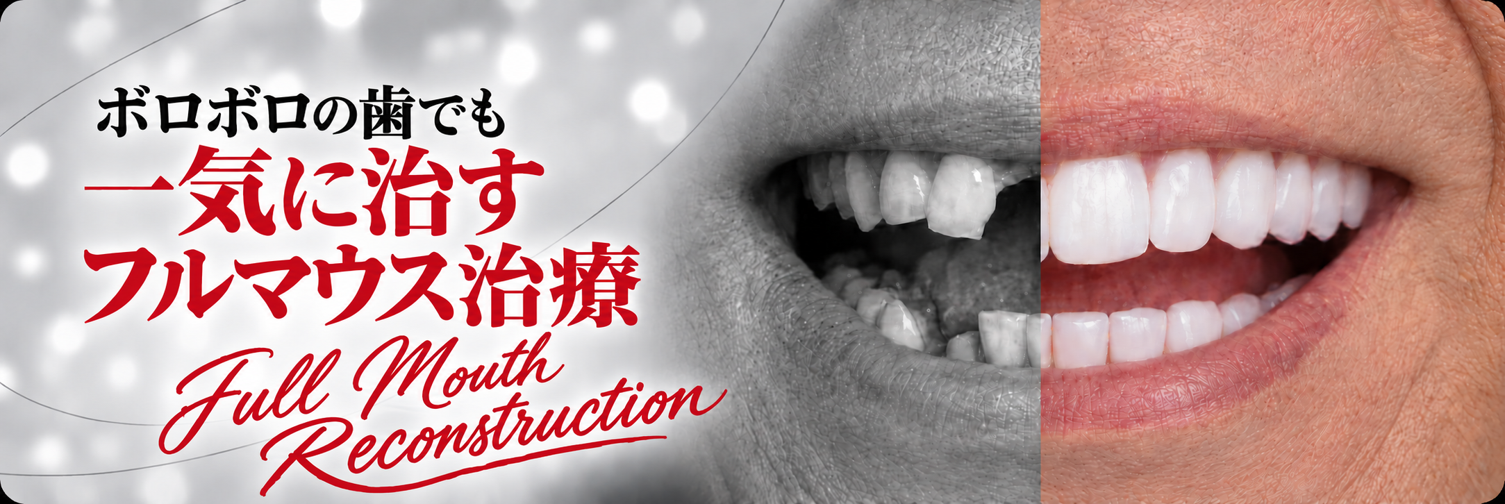 ボロボロの歯でも｜一気に治す｜フルマウス治療｜Full Mouth Reconstruction