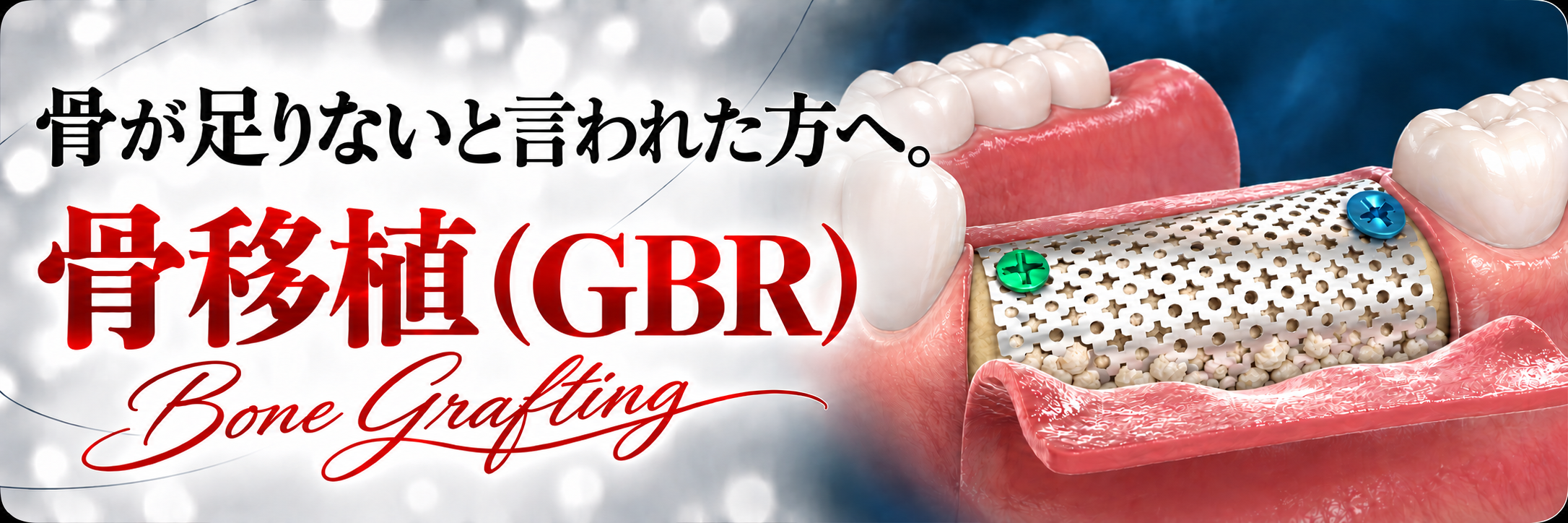 骨が足りないと言われた方へ。骨移植（GBR）｜Bone Grafting