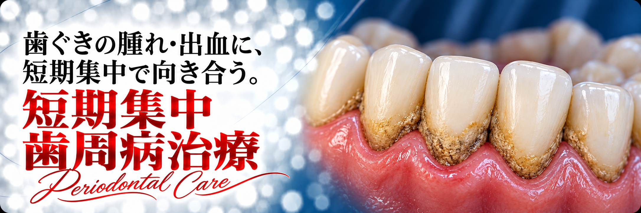歯ぐきの腫れ・出血に、短期集中で向き合う。短期集中歯周病治療｜Periodontal Care