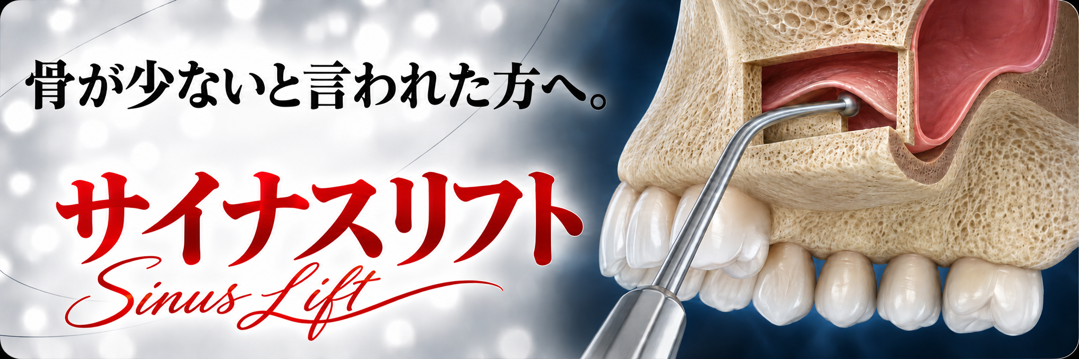 骨が少ないと言われた方へ。サイナスリフト｜Sinus Lift