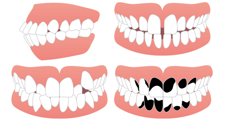 セラミック矯正は、口ゴボ、すきっ歯、乱食歯の歯並び矯正に最適です