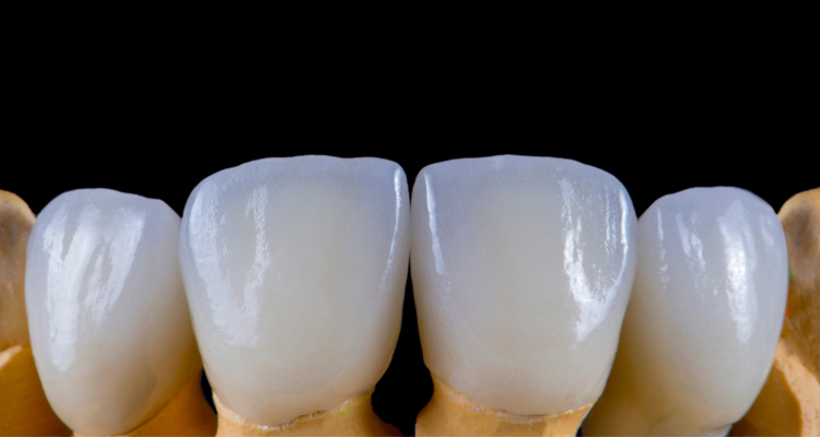 歯科&矯正歯科オーラルデザインクリニック秋葉原のセラミック矯正なら歯の色や形を同時に治せます