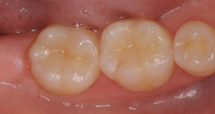 銀歯をセラミックインレーに変える症例、術後