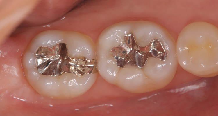 銀歯をセラミックインレーに変える症例、術前