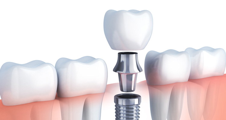 歯科&矯正歯科オーラルデザインクリニック秋葉原のインプラント治療なら欠損部分のみ治療できるため、他の歯に影響がありません