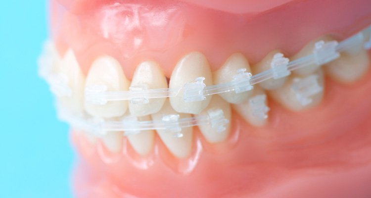 歯科＆矯正歯科オーラルデザインクリニック秋葉原のワイヤー矯正ならブラケットが目立たない