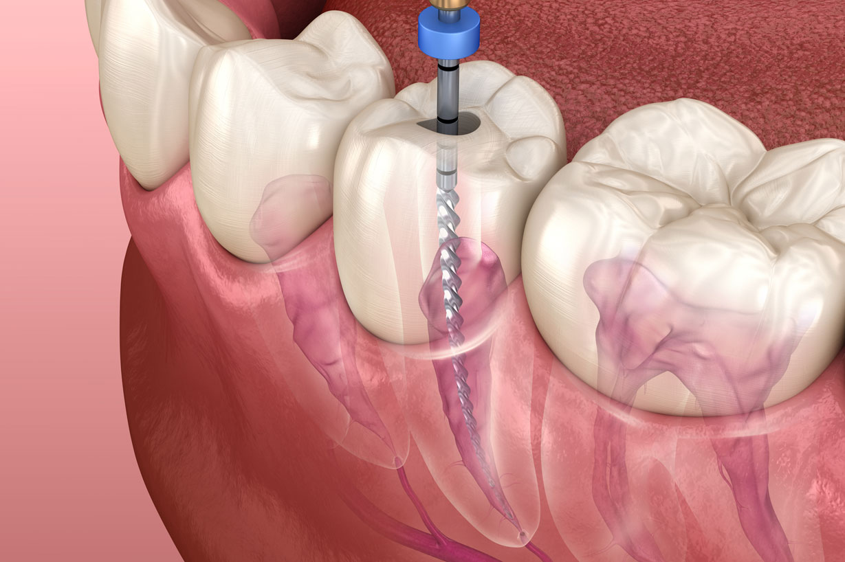 歯の神経を抜くとどうなるの？