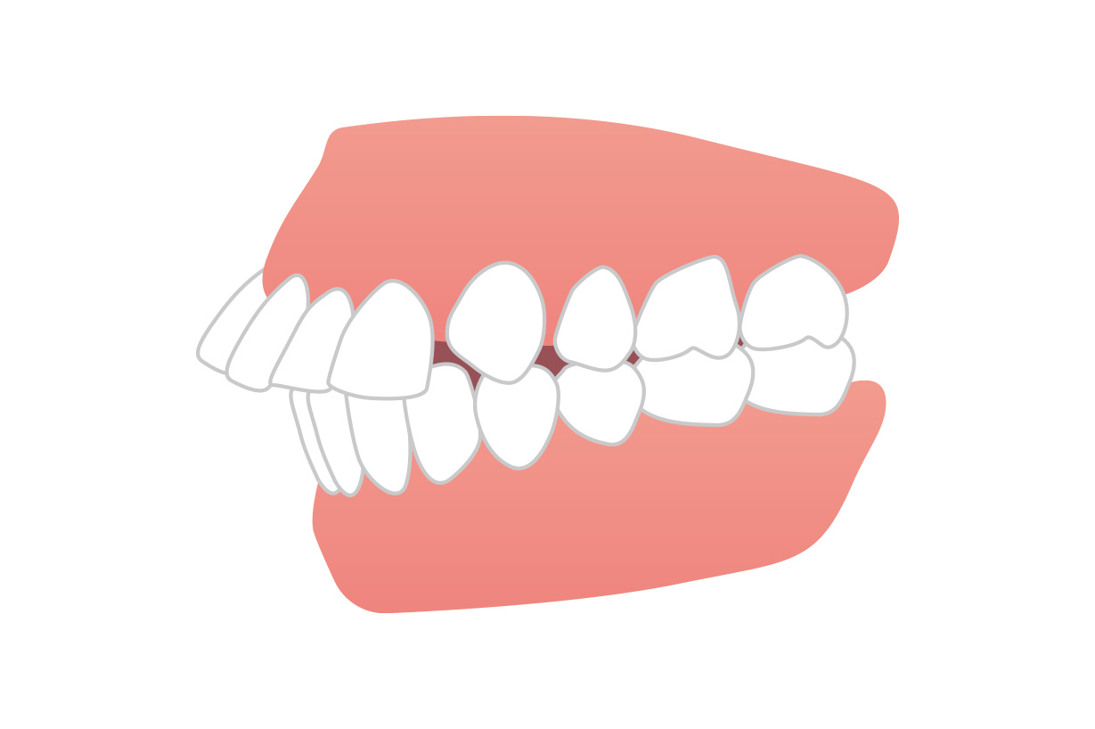 出っ歯の原因と矯正治療