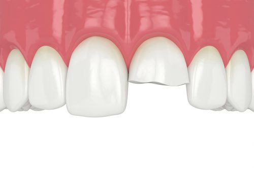 歯科＆矯正歯科オーラルデザインクリニック秋葉原で行う欠損歯の治療
