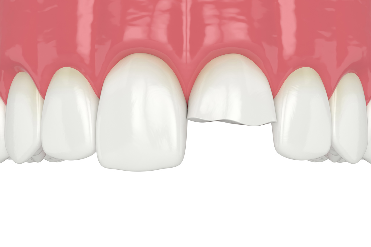 歯科＆矯正歯科オーラルデザインクリニック秋葉原で行う欠損歯の治療