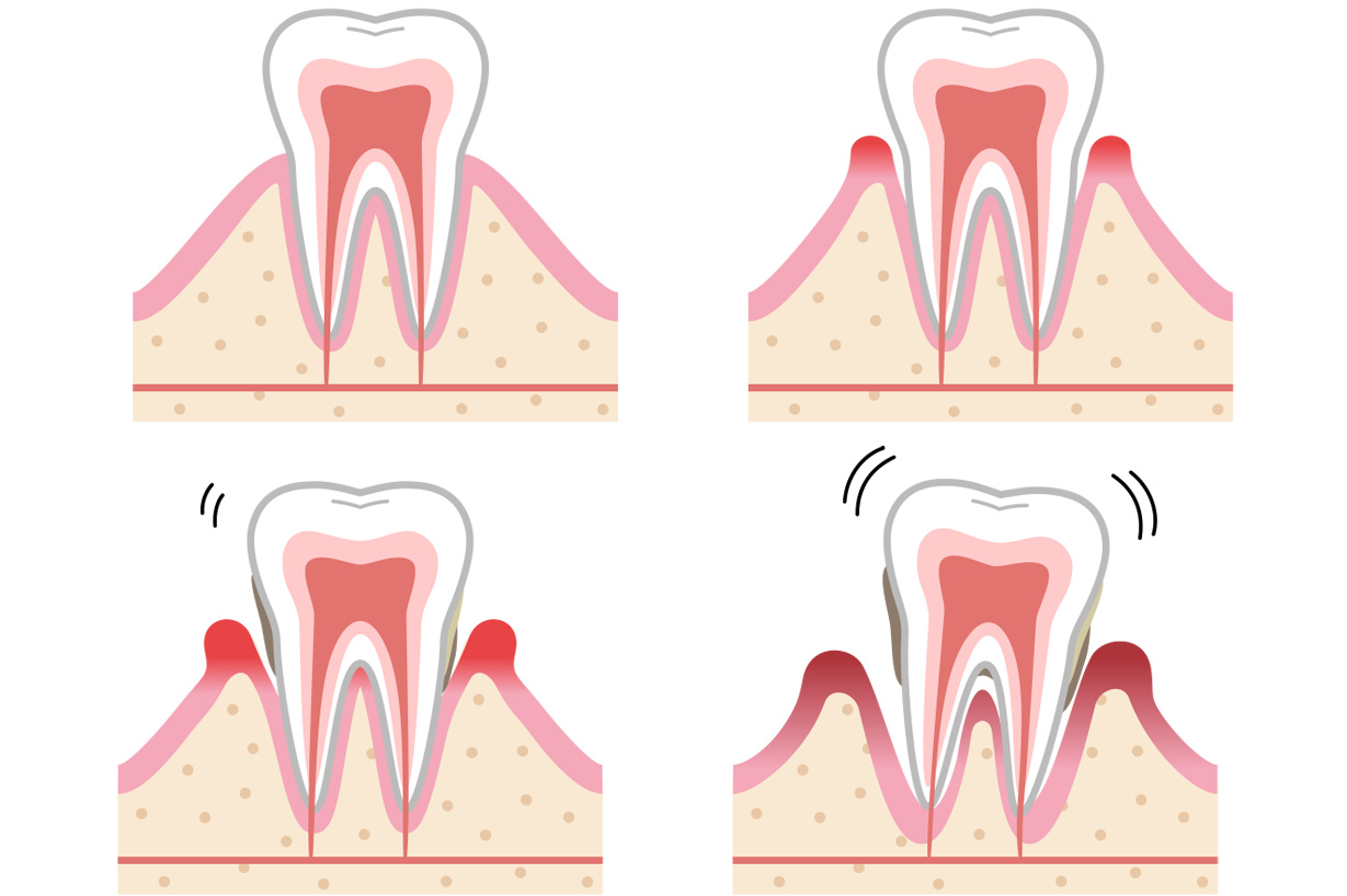歯周病の進行具合