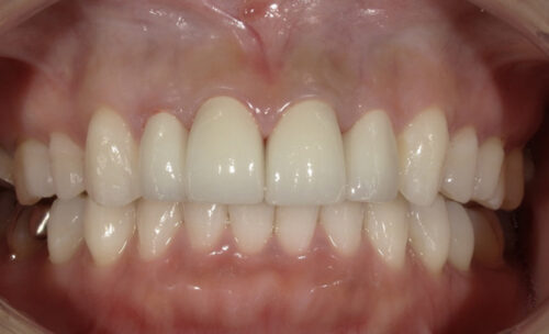 前歯の変色と歯並びの後戻りに対し、セラミック治療で審美性と機能性を改善した症例の治療後