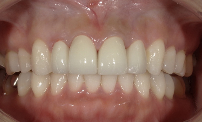 前歯の変色と歯並びの後戻りに対し、セラミック治療で審美性と機能性を改善した症例の治療後