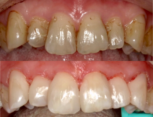 ダイレクトボンディングの症例