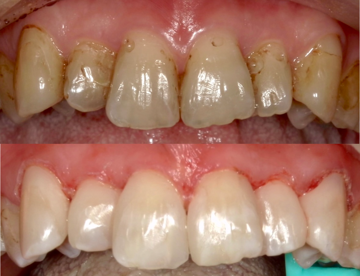 ダイレクトボンディングの症例