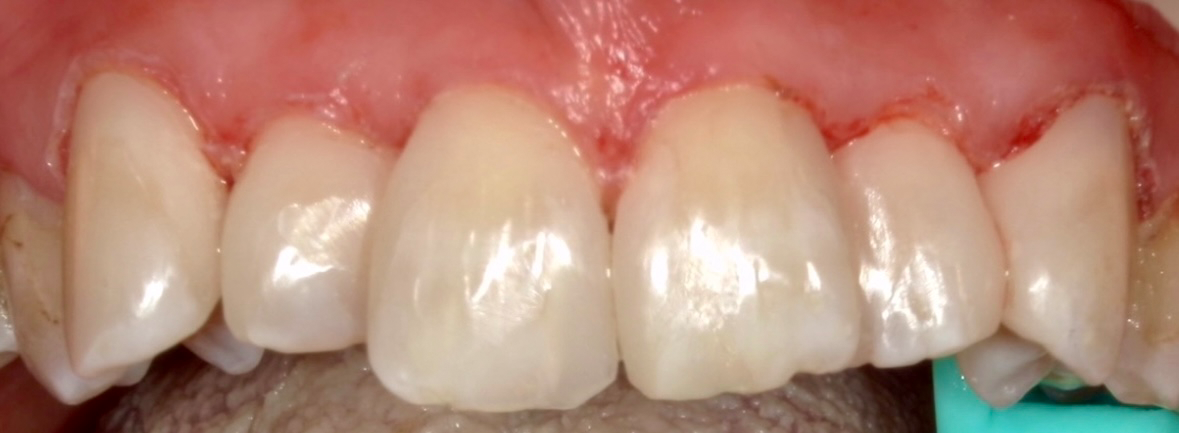 ダイレクトボンディングの症例の治療後
