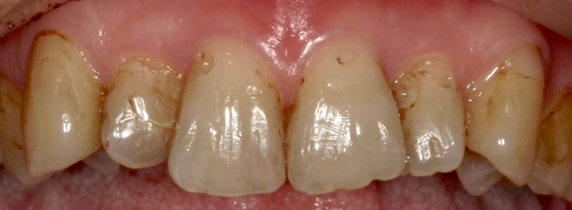 ダイレクトボンディングの症例の治療前