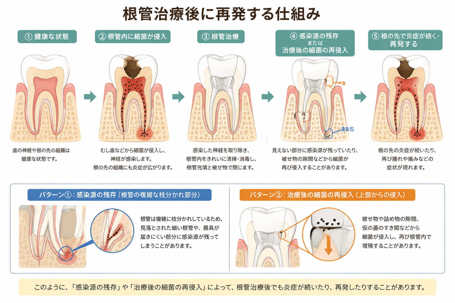 根管治療後に再発する仕組み