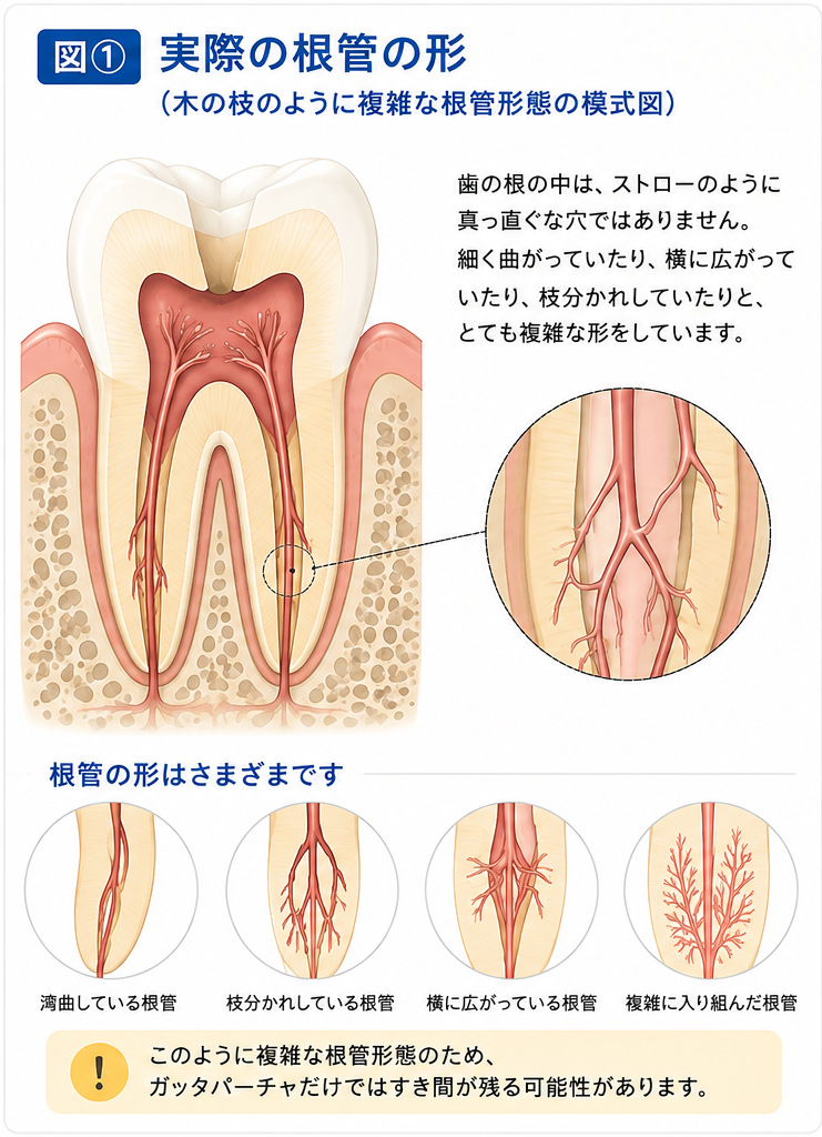 実際の根管の形
