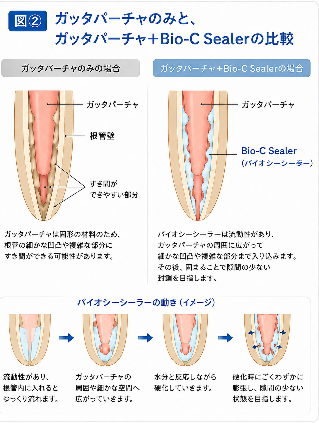 ガッタパーチャのみと、ガッタパーチャ+Bio-C Sealerの比較模式図